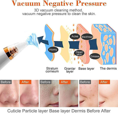 Glow effortlessly with the Blackhead Removal Machine